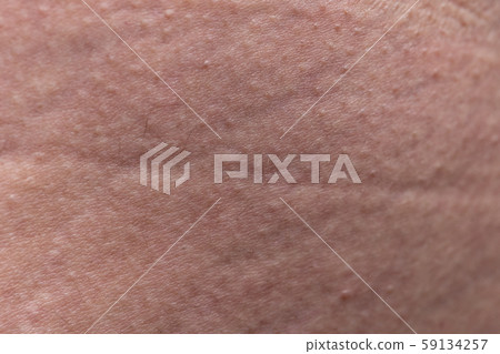 Pattern of human's skin with the stretch marks, closeup photo Pattern of human's skin with the stretch marks, closeup photo 59134257