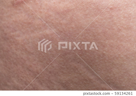 Texture of human's skin with the stretch marks, closeup photo Texture of human's skin with the stretch marks, closeup photo 59134261