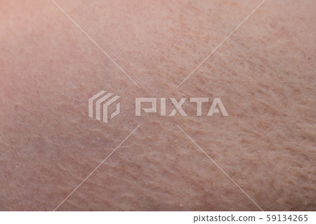 Texture of human's skin with the scar burn Texture of human's skin with the scar burn 59134265