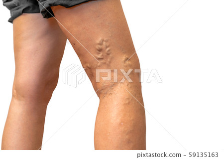 Legs pain concept - legs tied with rope isolated on white Legs pain concept - legs tied with rope isolated on white 59135163