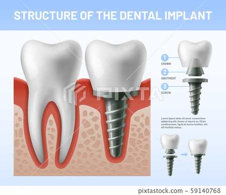 Dental teeth implant. Implantation procedure or tooth crown abutments. Health care vector Dental teeth implant. Implantation procedure or tooth crown abutments. Health care vector 59140768