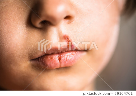 Herpes on upper lip of little girl. Herpes on upper lip of little girl. 59164761