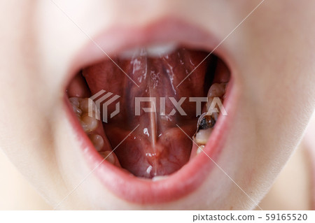 little girl opens her mouth and shows sick tooth little girl opens her mouth and shows sick tooth 59165520