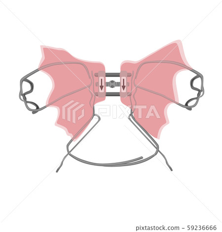 Palatal expander for the maxilla, vector illustration. The removable orthodontic appliance to make Palatal expander for the maxilla, vector illustration. The removable orthodontic appliance to make 59236666