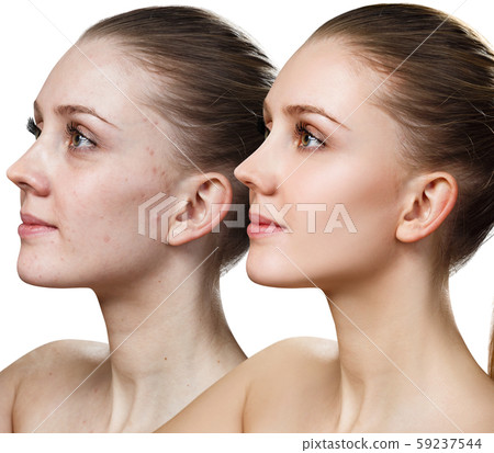Comparison portrait of young woman before and after retouch. 59237544