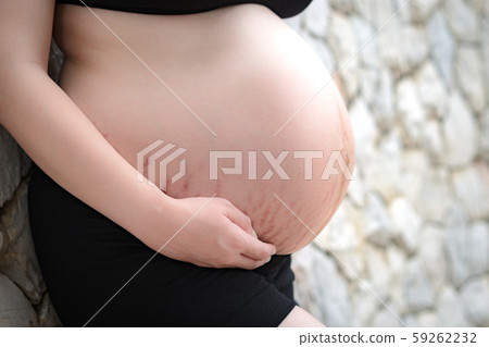 Closeup of a beautiful and healthy pregnancy woman that is close to the due date with stretch marks on belly skin. Woman health and Beauty. Mother's love, Skincare, Scar care, Happy Pregnant, Summer. 59262232