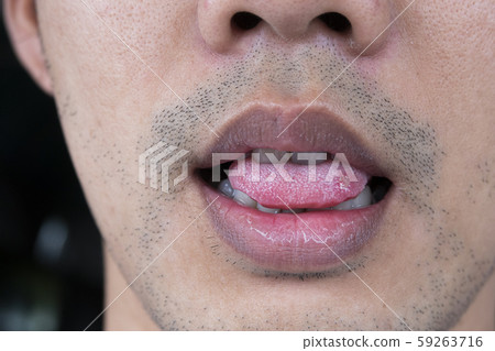 Close-up Sore tongue 59263716