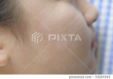 皮膚疾病治療後（唇皰疹，身上的癬） 59264563