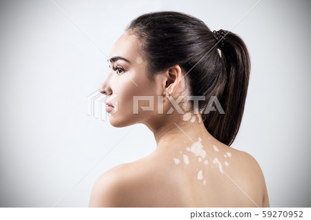 Portrait of beautiful woman with vitiligo. Portrait of beautiful woman with vitiligo. 59270952