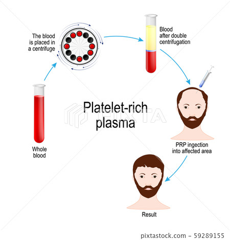 hair, prp, plasma 59289155