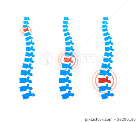Vector human spine with pain isolated silhouette 59290186