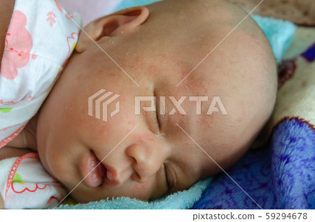 Newborn baby Asian  has rash 59294678