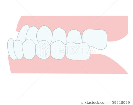 下頜前牙錯合 下頜前牙錯合 59318039