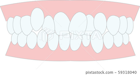 咬合不良擁擠的牙齒 59318040
