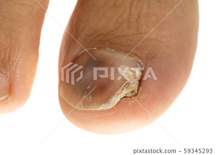一個男人的腳趾爪被水蟲弄碎了 59345293
