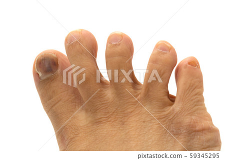 Nail athlete's foot Nail athlete's foot 59345295