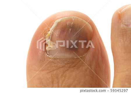 指甲運動員的腳 59345297