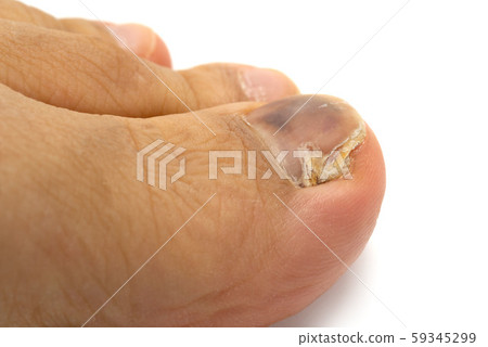 指甲運動員的腳 59345299