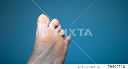 Fungus infection underneath man foot 59402518