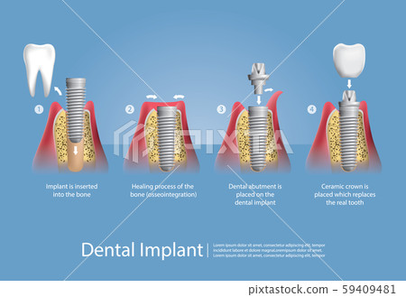 Human teeth and Dental implant Vector Illustration Human teeth and Dental implant Vector Illustration 59409481