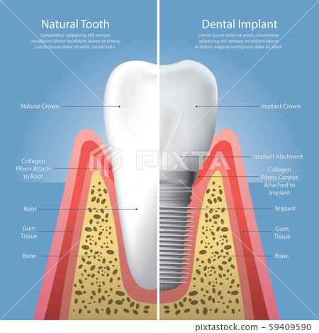 Human teeth and Dental implant Vector Illustration 59409590