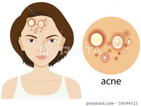Diagram showing woman with acne problem Diagram showing woman with acne problem 59544515