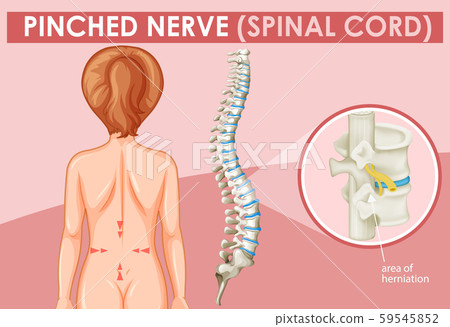 Diagram showing pinched nerve in human Diagram showing pinched nerve in human 59545852