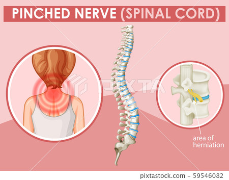 Diagram showing pinched nerve in human 59546082