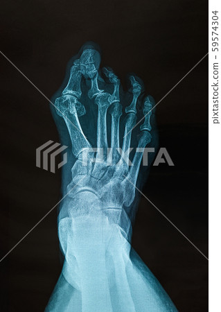 X-ray of the right foot. X-ray of the right foot. 59574304