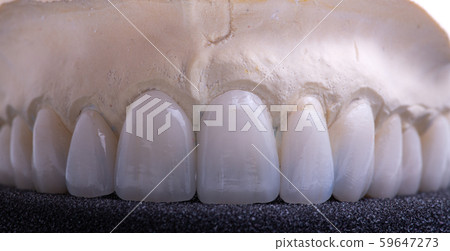 Dental crowns. Close-up ceramic tooth crown Dental crowns. Close-up ceramic tooth crown 59647273