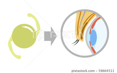 Intraocular lens and eye cross-section 59664511