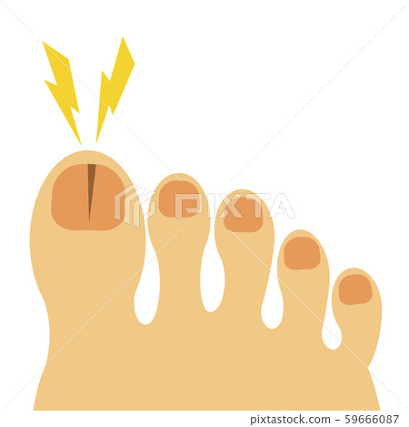 腳趾甲破裂 腳趾甲破裂 59666087