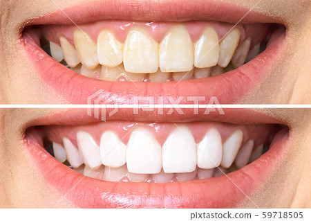 woman teeth before and after whitening. Over white background woman teeth before and after whitening. Over white background 59718505