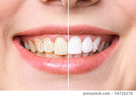 woman teeth before and after whitening. Over white background. Dental clinic patient. Image woman teeth before and after whitening. Over white background. Dental clinic patient. Image 59720270