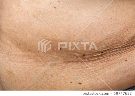 Senior women body fat belly front view, Black moles, Unhealthy concept Senior women body fat belly front view, Black moles, Unhealthy concept 59747632