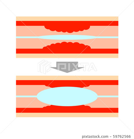 血管支架治療 59762566
