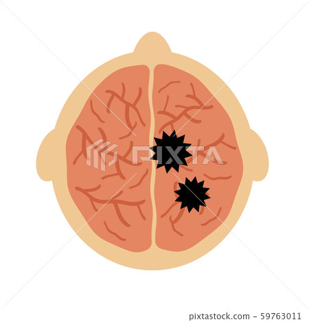 進入大腦的病毒 進入大腦的病毒 59763011