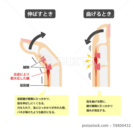 彈簧手指/彈簧手指（排斥手指）/原因和症狀骨骼解剖圖/日語（帶說明文字） 59800432