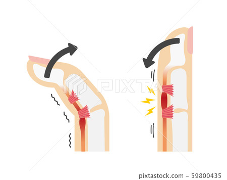 Spring finger / spring finger (elastic finger) / cause and symptom Skeleton anatomical illustration / no letters Spring finger / spring finger (elastic finger) / cause and symptom Skeleton anatomical illustration / no letters 59800435