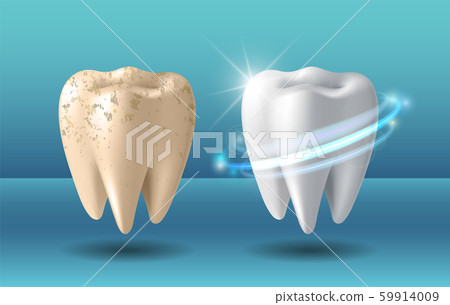Clean and dirty tooth before and after whitening 59914009