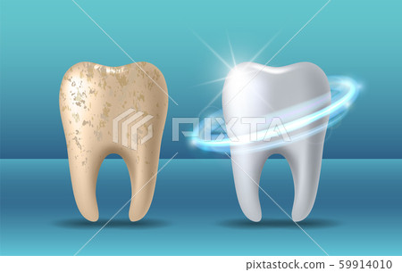 Clean and dirty tooth before and after whitening 59914010
