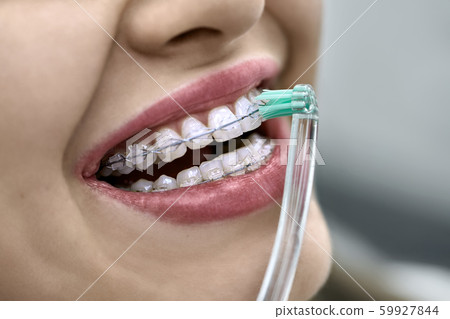Closeup view at female teeth with bracket system Closeup view at female teeth with bracket system 59927844