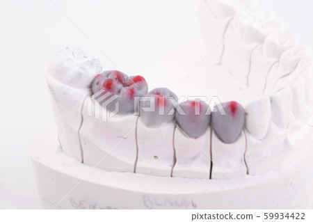 Dental Prosthesis work. Artificial tooth, prosthetic, false teeth 59934422