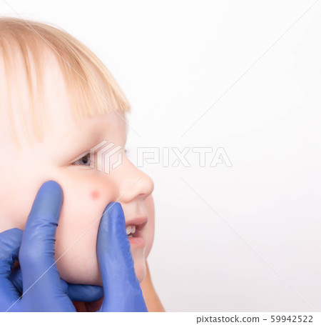 Doctor allergist examines a red pimple on the face of a little girl's child for the presence of an allergy to sweets, copy space, dermatitis 59942522