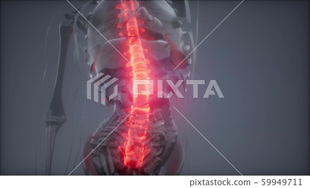 Backache in Back Bones Backache in Back Bones 59949711