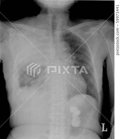Chest tomography,X-ray of a human to find the disorder of the lungs. Photo tomography pulmonary tuberculosis patients. 59971441
