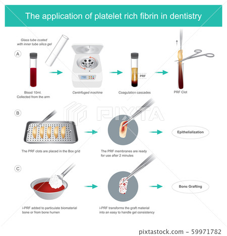 Fibrin-rich platelets (PRF) in dentistry. 59971782