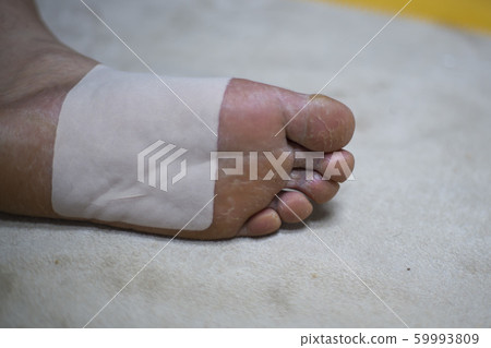 Foot, athlete's foot, skin disease Foot, athlete's foot, skin disease 59993809