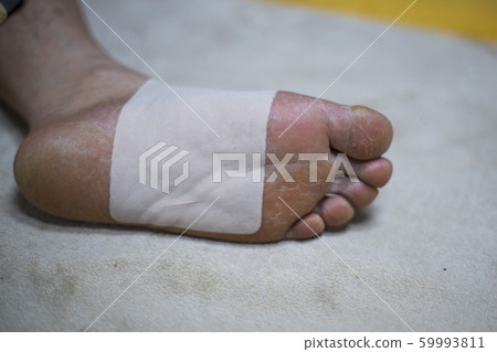 Foot, athlete's foot, skin disease Foot, athlete's foot, skin disease 59993811