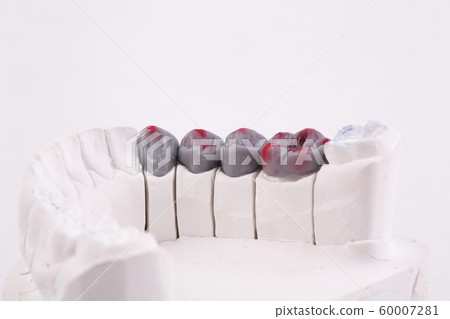 Dental Prosthesis work. Artificial tooth, prosthetic, false teeth 60007281